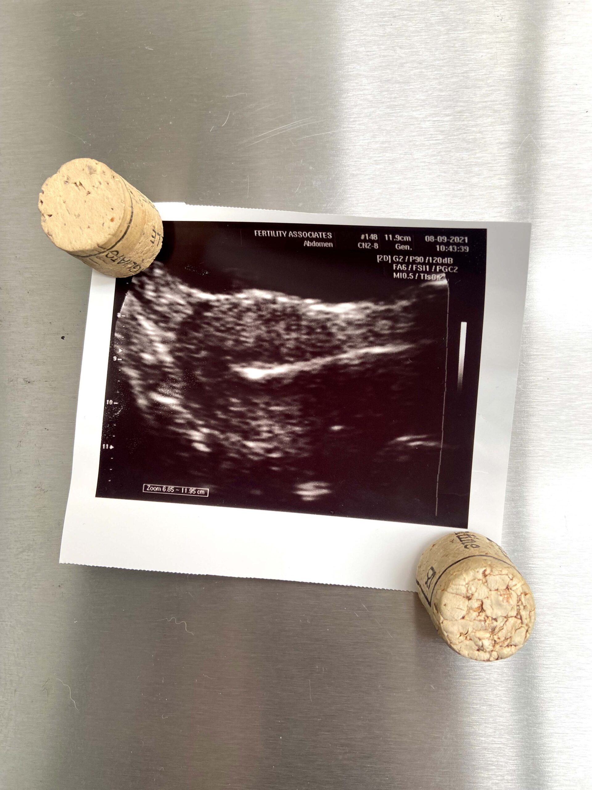 A Polaroid of a scan of a uterus pinned to a fridge