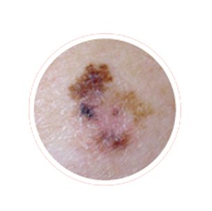 Melanoma with uneven colour