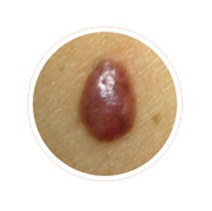 Example of melanoma