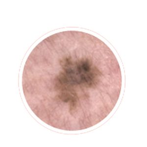 Evolving melanoma example