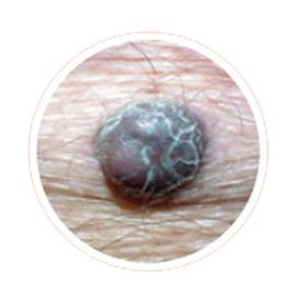 example  of a firm melanoma