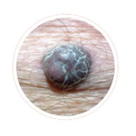 example of a firm melanoma