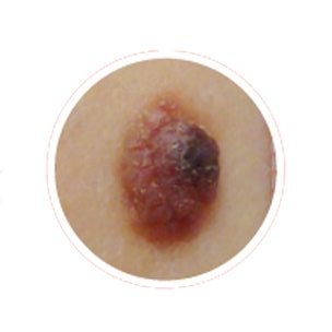 Asymmetrical melanoma