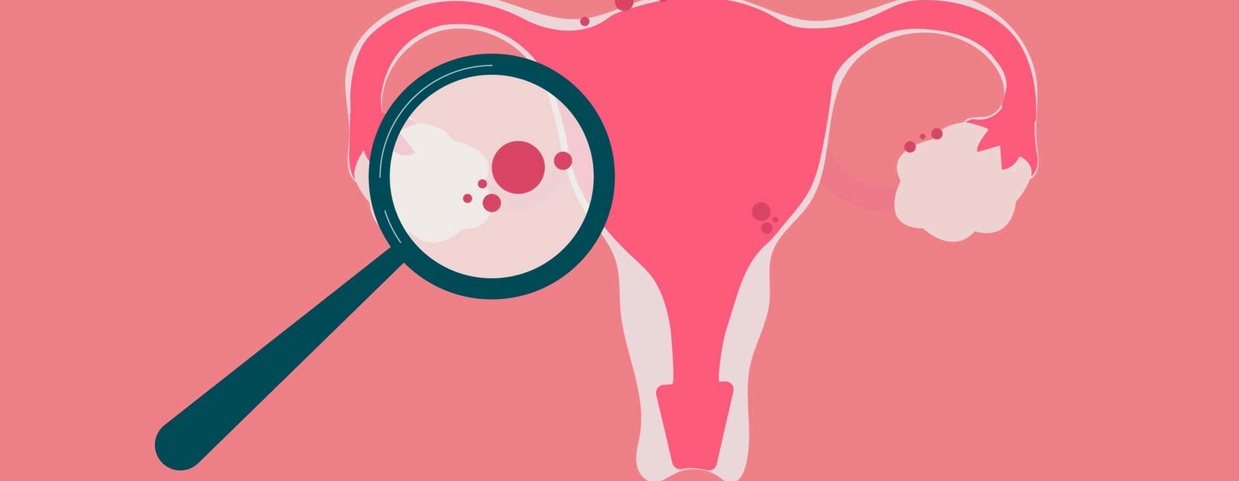 endometriosis-concept-illustration